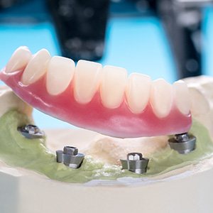 A model of implant dentures on table in Phoenix