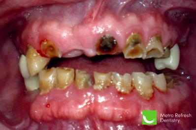 Close up of unhealthy teeth