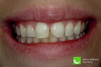 Close up of unhealthy teeth