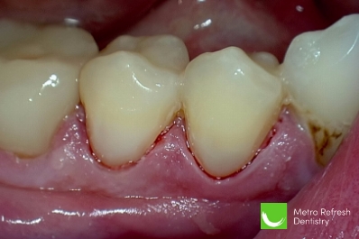 Close up of healthy teeth