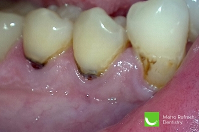 Close up of unhealthy teeth