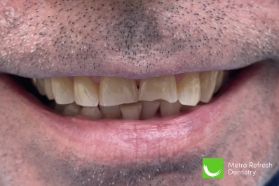 Close up of unhealthy teeth