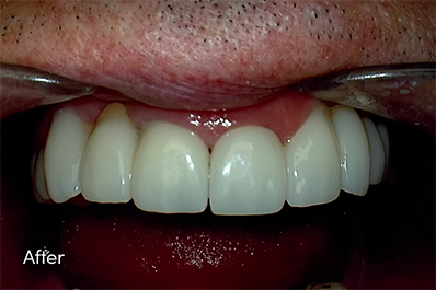 Close up of healthy teeth