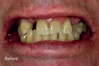 Close up of unhealthy teeth