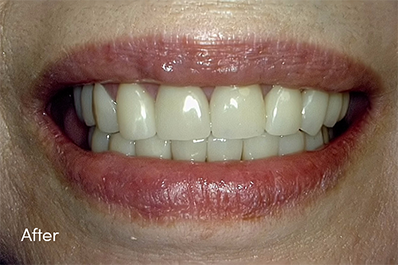 Close up of healthy teeth