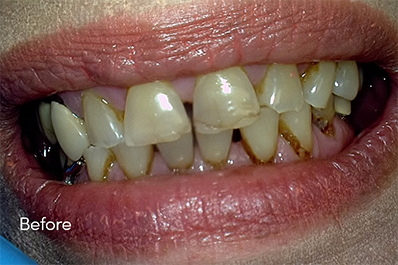 Close up of unhealthy teeth
