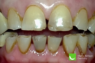 Close up of unhealthy teeth