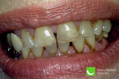 Close up of unhealthy teeth