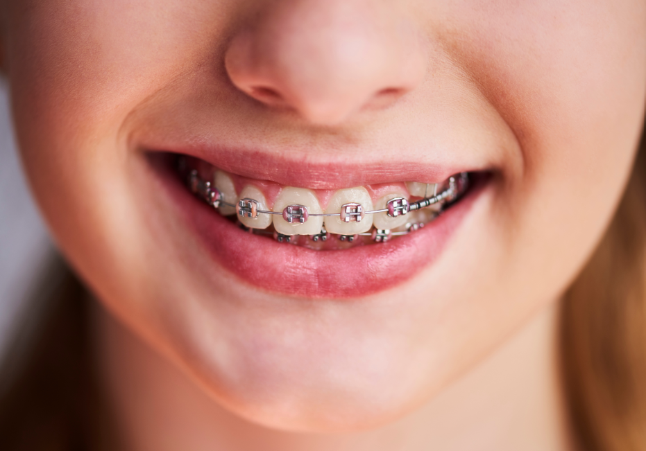 Close up of girl's braces