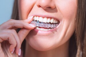 Woman fitting clear aligner on to her teeth.